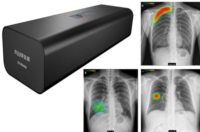 胸部X線画像病変検出機能（AIユニット）